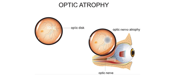 optic nerve atrophy