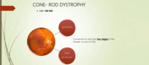 Stem cell treatment for Rod and Cone Dystrophy