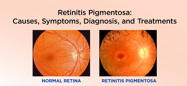 rp treatment with stem cell therapy