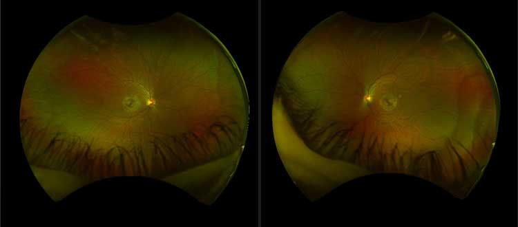 macular dystrophy