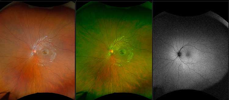 macular dystrophy