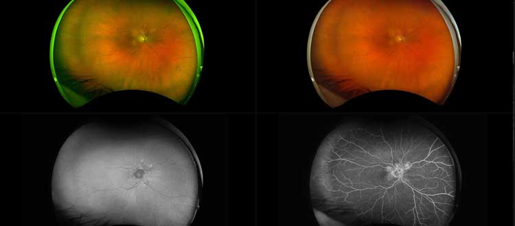 macular dystrophy