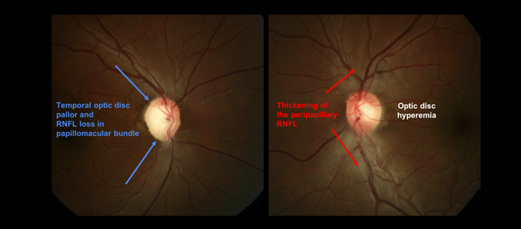 optic atrophy treatment in oman