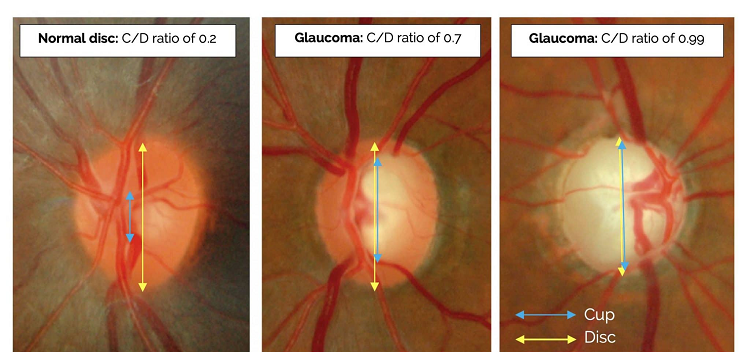 glaucoma optic atrophy