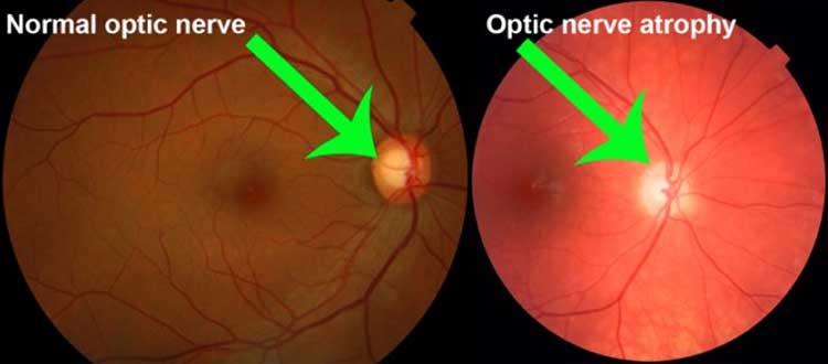 glaucoma optic atrophy