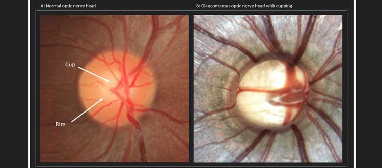 glaucoma stem ceel treatment