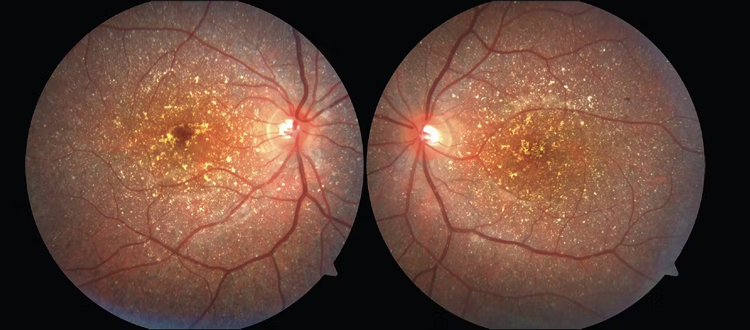 retinal-dystrophy