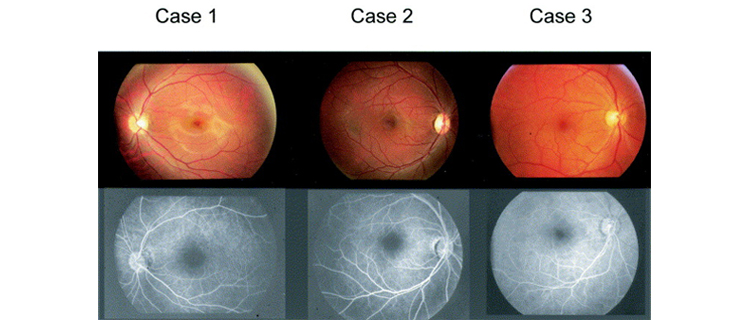 rod-&-cone-dystrophy